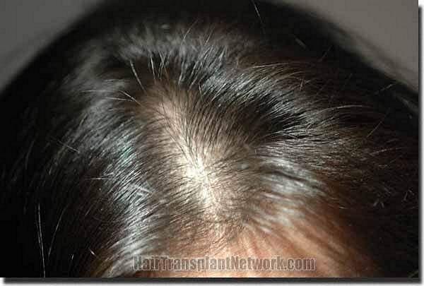 Hair restoration procedure results