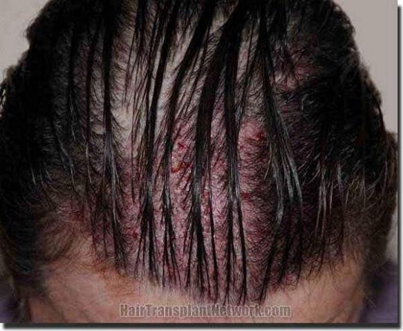 Hair restoration procedure results