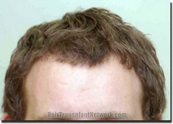 Hair restoration procedure results