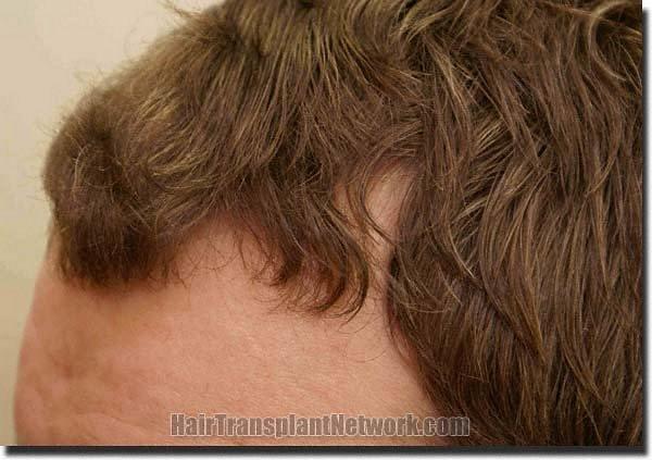 Hair restoration procedure results