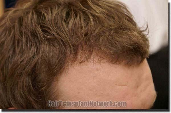 Hair restoration procedure results