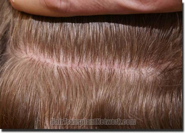 Hair restoration procedure results