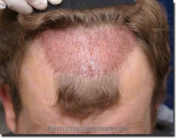 Hair restoration procedure results