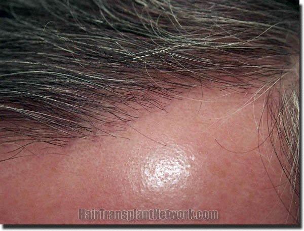 Hair restoration procedure results