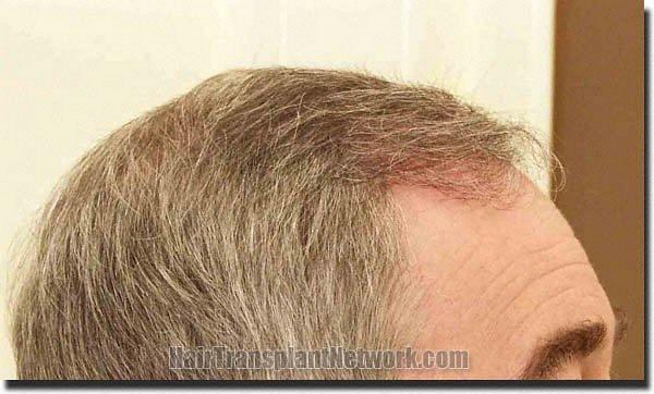 Hair restoration procedure results