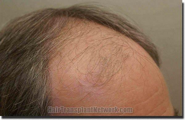 Hair restoration procedure results