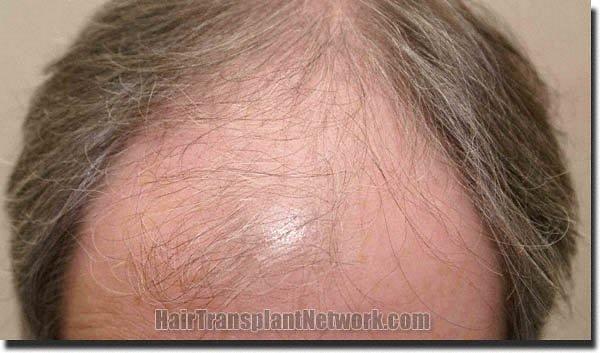 Hair restoration procedure results