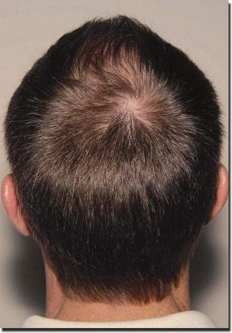 Hair restoration procedure results