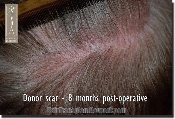 Hair restoration procedure results