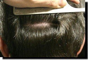 Hair restoration procedure results