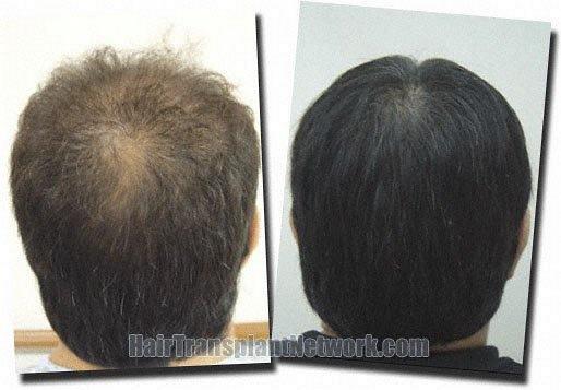 Hair restoration procedure results