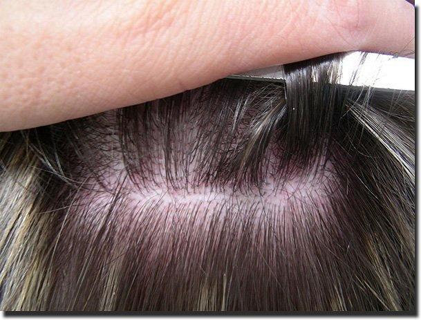 Hair restoration procedure results