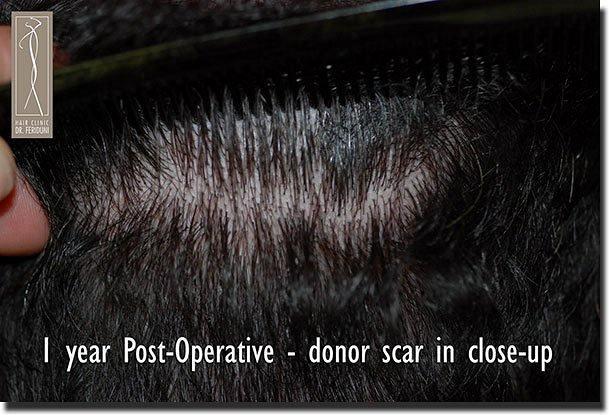 Hair restoration procedure results