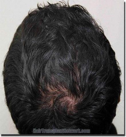 Hair restoration procedure results