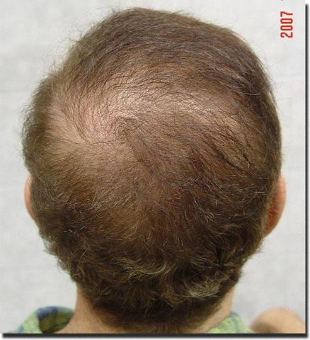 Hair restoration procedure results