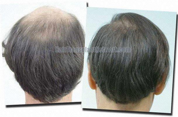 Hair restoration procedure results