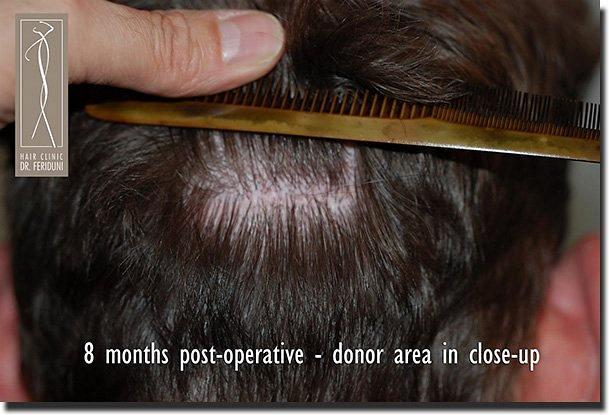 Hair restoration procedure results