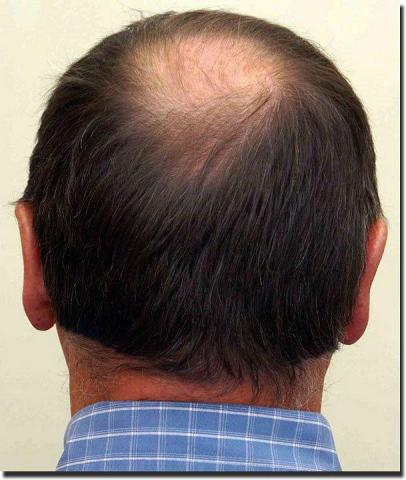 Hair restoration procedure results