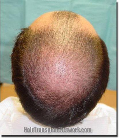 Hair restoration procedure results