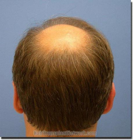 Hair restoration procedure results