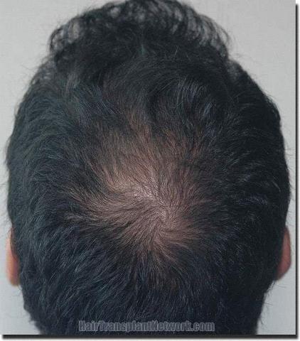 Hair restoration procedure results