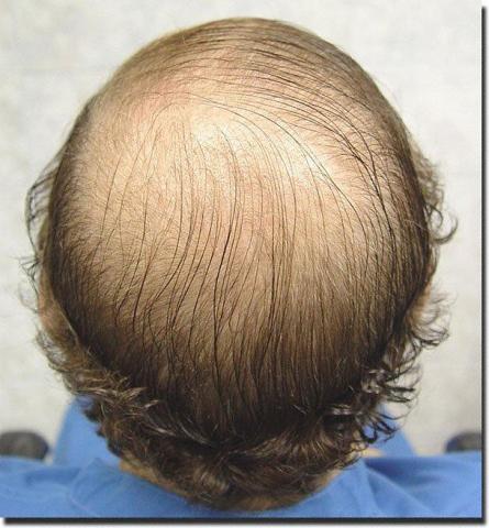 Hair restoration procedure results