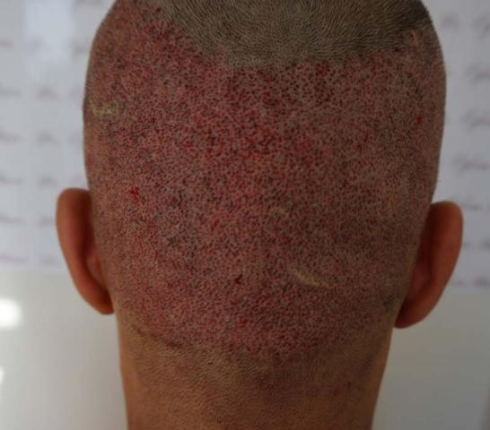 Back of patient, showing donor area immediately after FUE