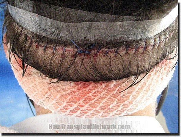 Hair restoration procedure results