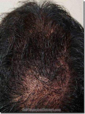 Hair restoration procedure results