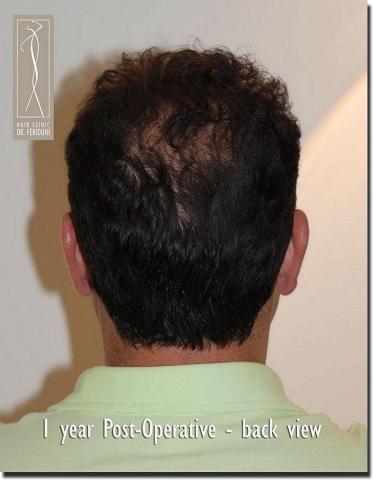 Hair restoration procedure results