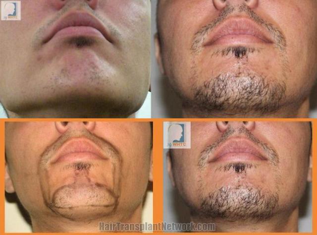 Beard transplant surgery before and after images