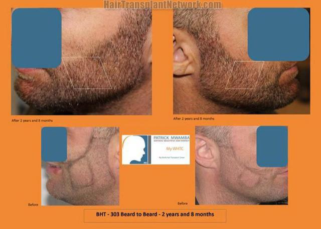 Beard restoration procedure before and after pictures