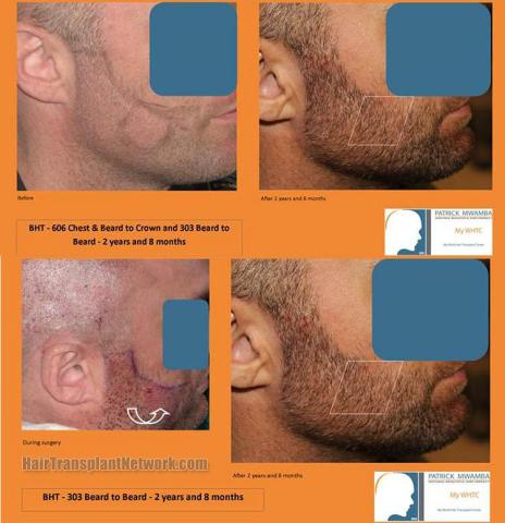 Beard restoration procedure before and after results