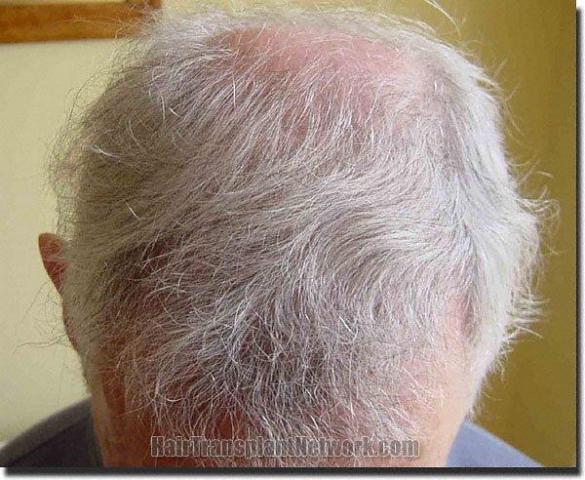 Hair restoration procedure results