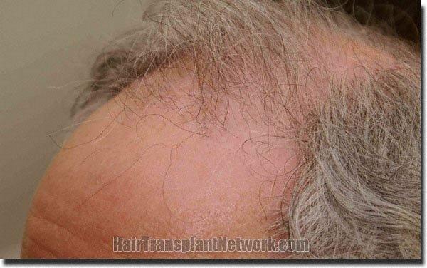 Hair restoration procedure results