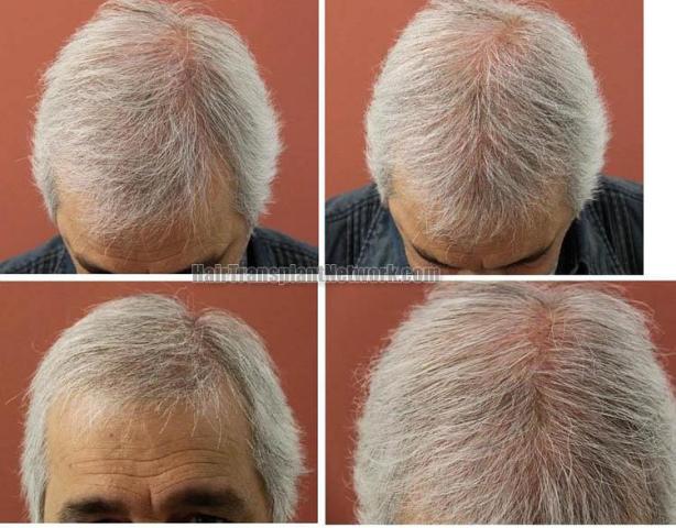 Hair restoration procedure before and after pictures