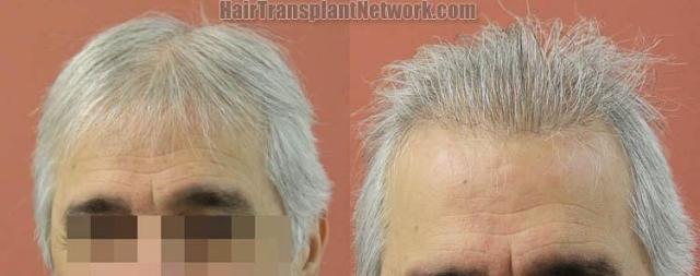 Hair restoration procedure before and after results