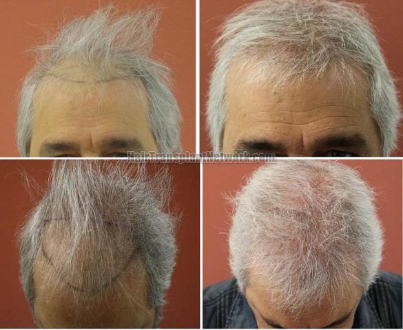 Hair restoration surgery before and after photos