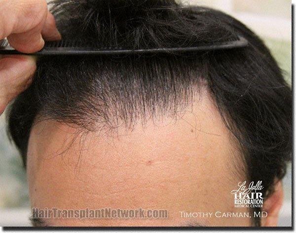 Hair restoration procedure results