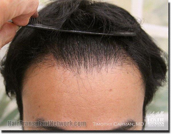 Hair restoration procedure results