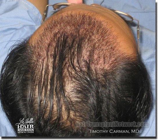 Hair restoration procedure results