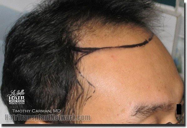 Hair restoration procedure results