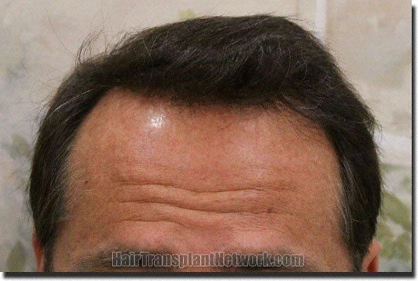 Hair restoration procedure results