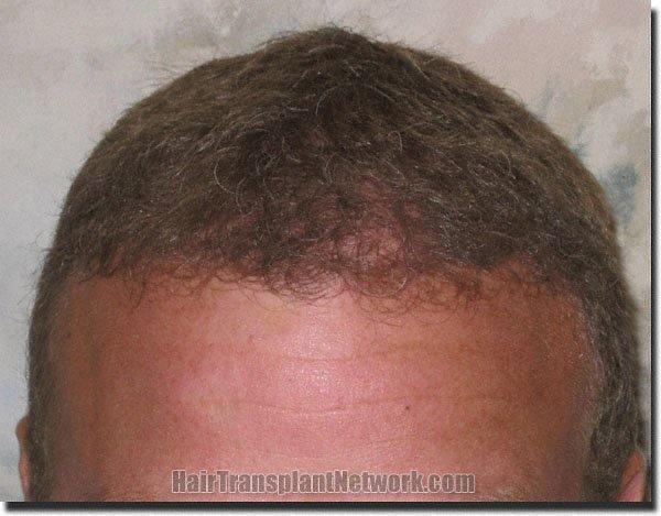 Hair restoration procedure results