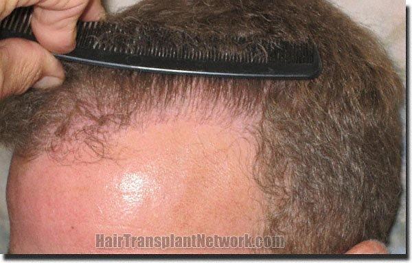 Hair restoration procedure results