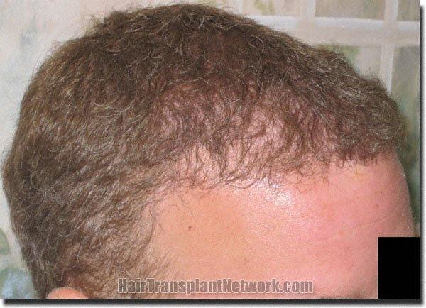 Hair restoration procedure results