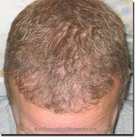 Hair restoration procedure results