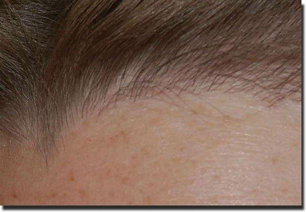 Hair restoration procedure results