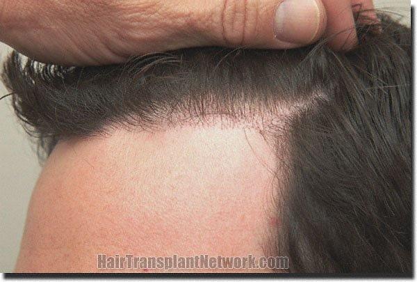 Hair restoration procedure results