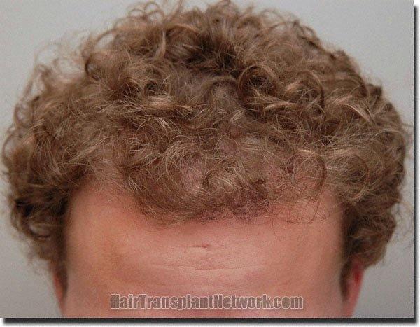 Hair restoration procedure results